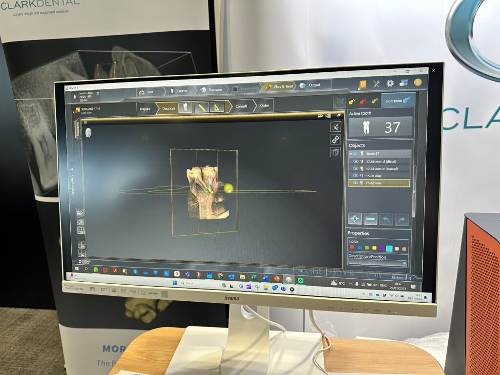 A computer screen showing a 3D mould of a tooth