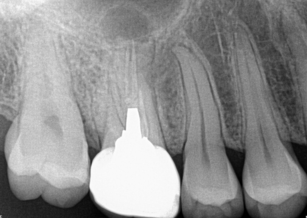 Tooth x-ray